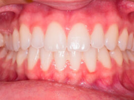 Claves para elegir ortodoncia invisible Claves para elegir ortodoncia invisible