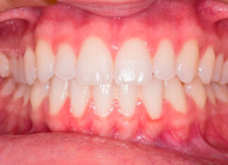 Claves para elegir ortodoncia invisible Claves para elegir ortodoncia invisible