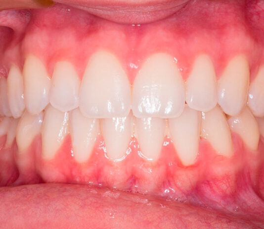 Claves para elegir ortodoncia invisible Claves para elegir ortodoncia invisible