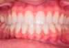 Claves para elegir ortodoncia invisible Claves para elegir ortodoncia invisible