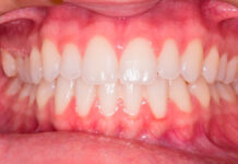 Claves para elegir ortodoncia invisible Claves para elegir ortodoncia invisible