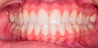 Claves para elegir ortodoncia invisible
