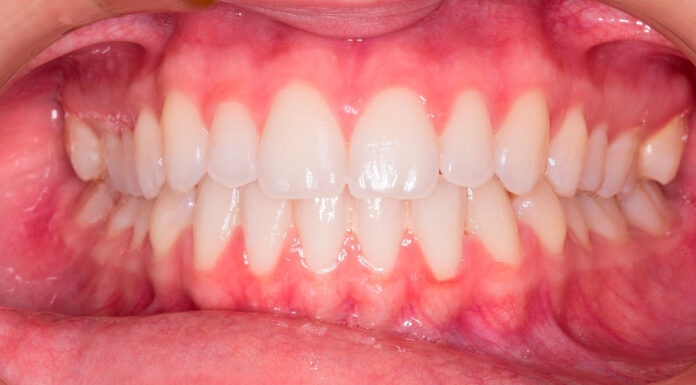 Claves para elegir ortodoncia invisible