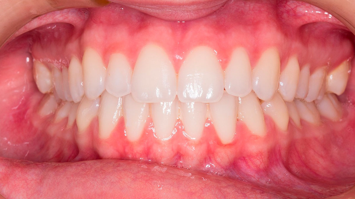 Claves para elegir ortodoncia invisible